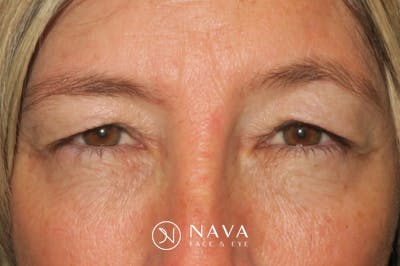 Upper Blepharoplasty (Upper Eyelid Surgery) Before & After Gallery - Patient 148992249 - Image 1