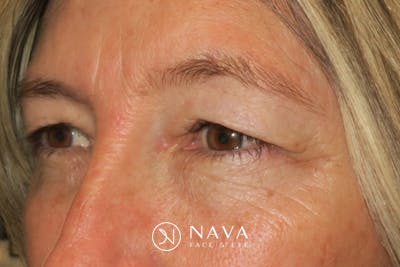 Upper Blepharoplasty (Upper Eyelid Surgery) Before & After Gallery - Patient 148992249 - Image 5
