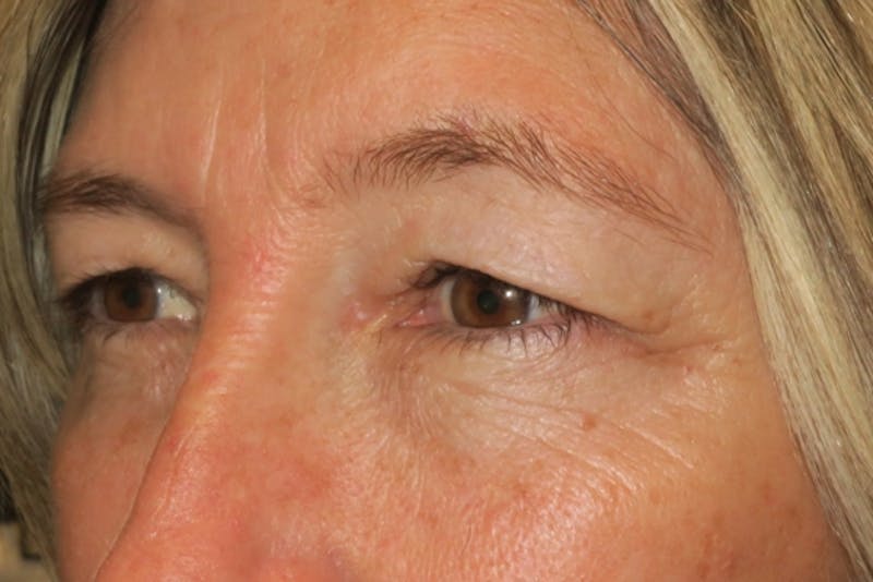 Upper Blepharoplasty (Upper Eyelid Surgery) Before & After Gallery - Patient 148992249 - Image 5