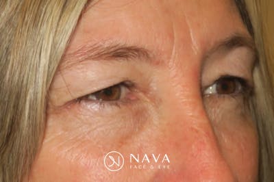 Upper Blepharoplasty (Upper Eyelid Surgery) Before & After Gallery - Patient 148992249 - Image 3