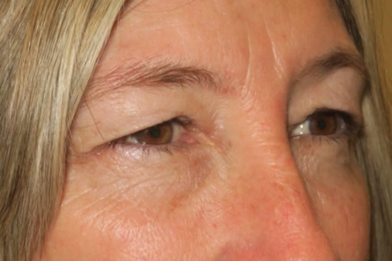 Upper Blepharoplasty (Upper Eyelid Surgery) Before & After Gallery - Patient 148992249 - Image 3