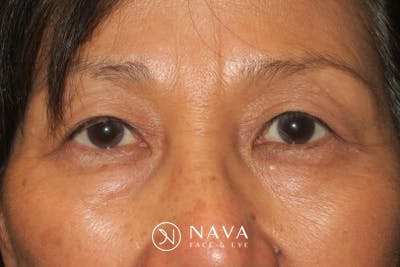Ptosis Repair Before & After Gallery - Patient 148992239 - Image 2