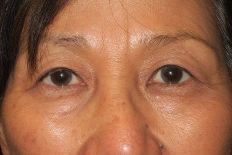Asian Eyelid Surgery Before & After Gallery - Patient 148992240 - Image 2