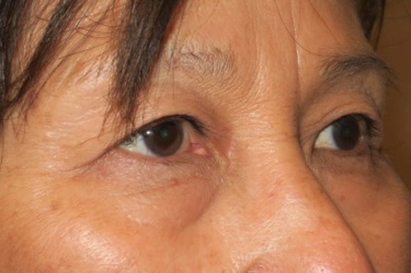 Ptosis Repair Before & After Gallery - Patient 148992239 - Image 4