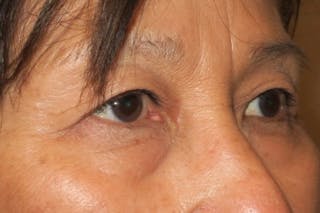 Ptosis Repair Before & After Gallery - Patient 148992239 - Image 4
