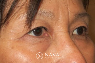 Ptosis Repair Before & After Gallery - Patient 148992239 - Image 4