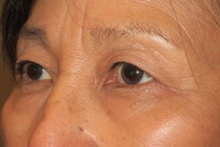 Ptosis Repair Before & After Gallery - Patient 148992239 - Image 6