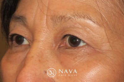 Ptosis Repair Before & After Gallery - Patient 148992239 - Image 6