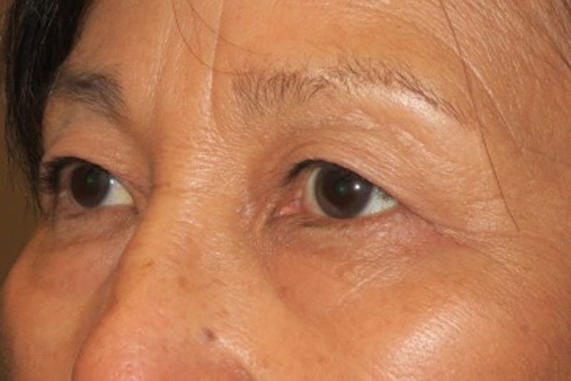 Ptosis Repair Before & After Gallery - Patient 148992239 - Image 6