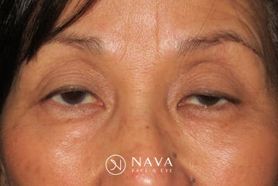 Ptosis Repair Before & After Gallery - Patient 148992239 - Image 1