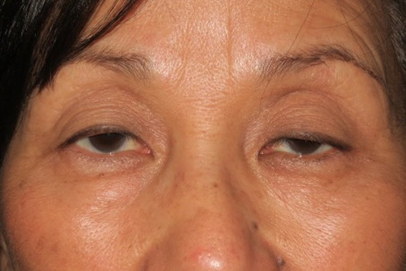 Ptosis Repair Before & After Gallery - Patient 148992239 - Image 1