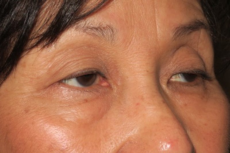 Ptosis Repair Before & After Gallery - Patient 148992239 - Image 3