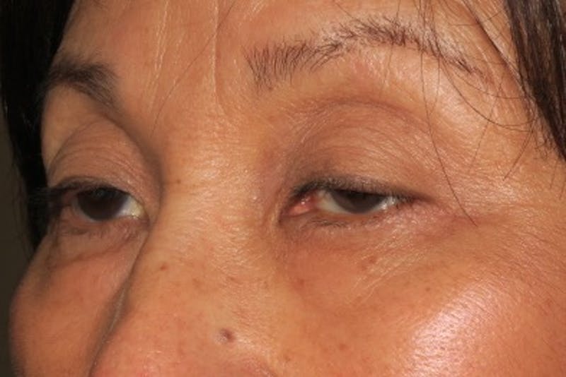 Asian Eyelid Surgery Before & After Gallery - Patient 148992240 - Image 5