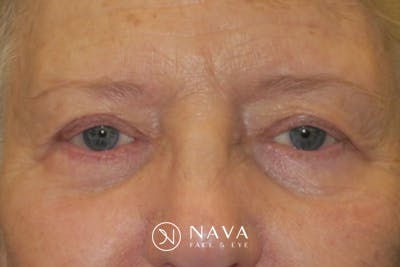 Ptosis Repair Before & After Gallery - Patient 148992244 - Image 2