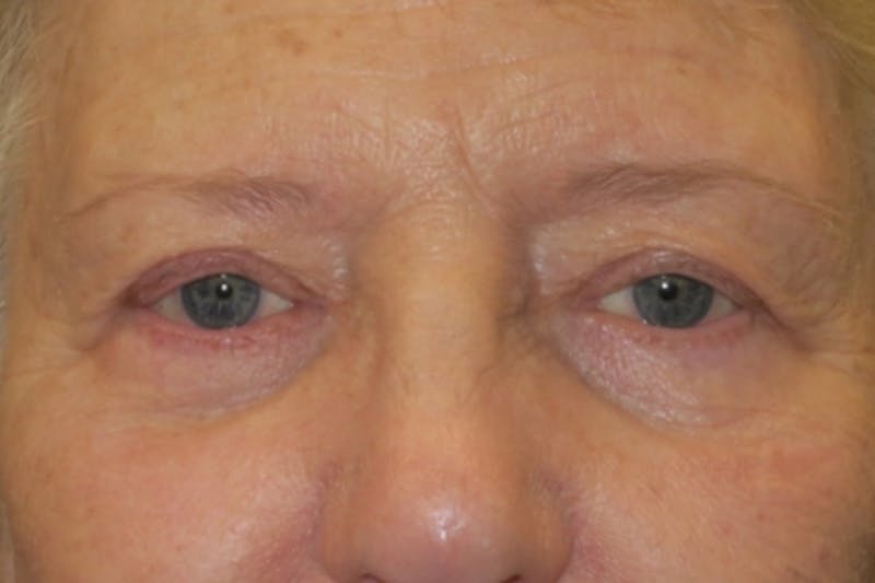 Ptosis Repair Before & After Gallery - Patient 148992244 - Image 2