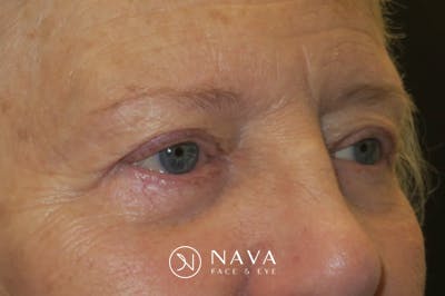 Ptosis Repair Before & After Gallery - Patient 148992244 - Image 4