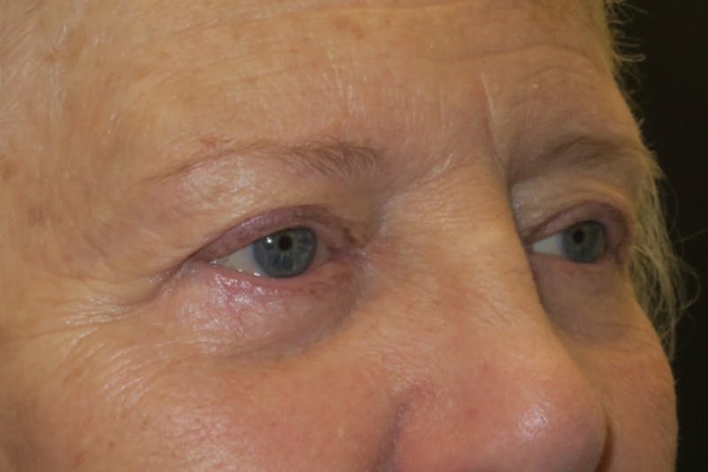 Ptosis Repair Before & After Gallery - Patient 148992244 - Image 4