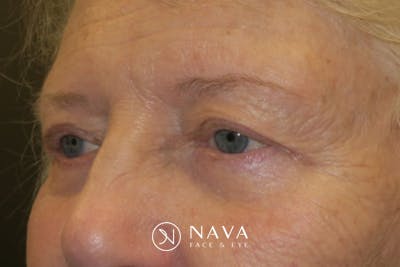Ptosis Repair Before & After Gallery - Patient 148992244 - Image 6