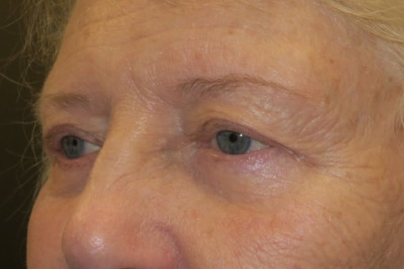 Ptosis Repair Before & After Gallery - Patient 148992244 - Image 6