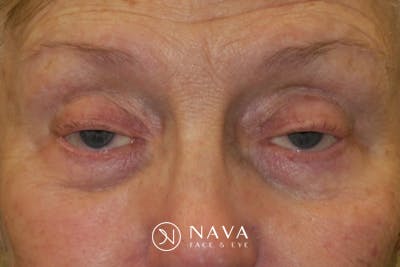 Ptosis Repair Before & After Gallery - Patient 148992244 - Image 1