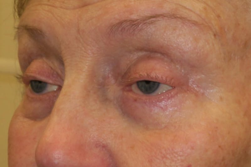 Ptosis Repair Before & After Gallery - Patient 148992244 - Image 5
