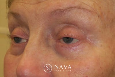 Ptosis Repair Before & After Gallery - Patient 148992244 - Image 5