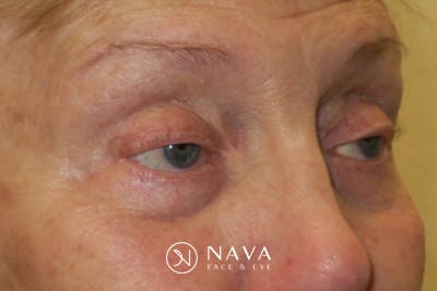 Ptosis Repair Before & After Gallery - Patient 148992244 - Image 3