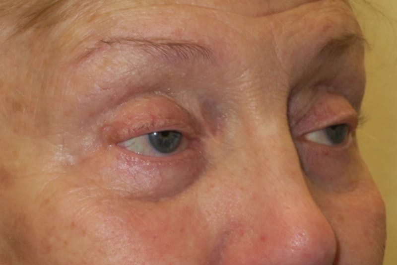Ptosis Repair Before & After Gallery - Patient 148992244 - Image 3