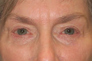 Lower Blepharoplasty (Lower Eyelid Surgery) Before & After Gallery - Patient 149192812 - Image 2