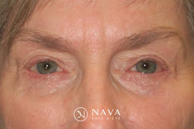Ptosis Repair Before & After Gallery - Patient 149192810 - Image 2