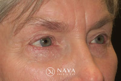 Ptosis Repair Before & After Gallery - Patient 149192810 - Image 4