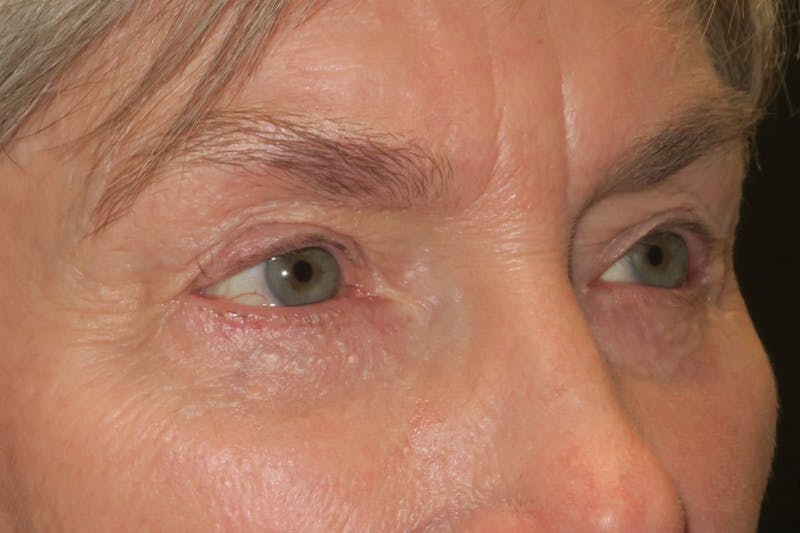 Lower Blepharoplasty (Lower Eyelid Surgery) Before & After Gallery - Patient 149192812 - Image 4