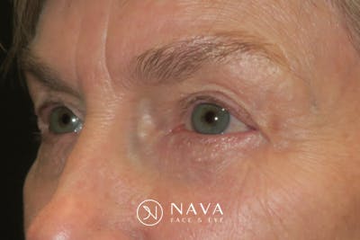 Ptosis Repair Before & After Gallery - Patient 149192810 - Image 6