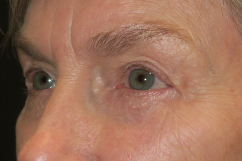 Ptosis Repair Before & After Gallery - Patient 149192810 - Image 6