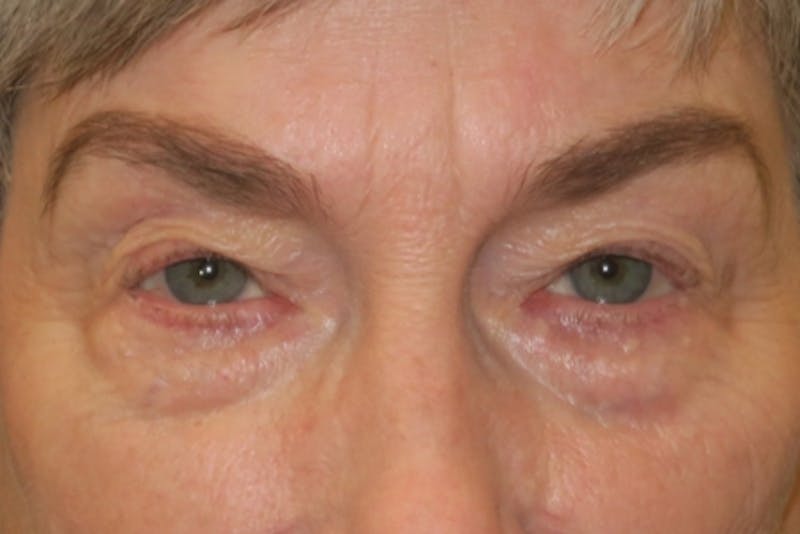 Lower Blepharoplasty (Lower Eyelid Surgery) Before & After Gallery - Patient 149192812 - Image 1