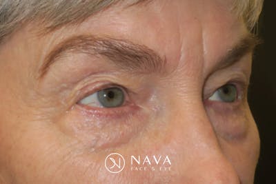 Ptosis Repair Before & After Gallery - Patient 149192810 - Image 3