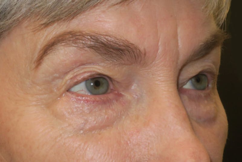Lower Blepharoplasty (Lower Eyelid Surgery) Before & After Gallery - Patient 149192812 - Image 3