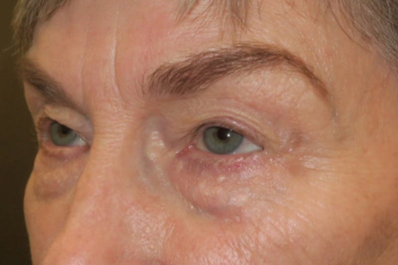 Lower Blepharoplasty (Lower Eyelid Surgery) Before & After Gallery - Patient 149192812 - Image 5