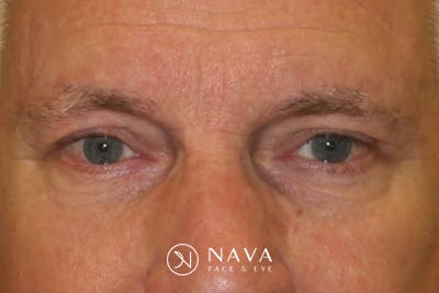 Ptosis Repair Before & After Gallery - Patient 149192813 - Image 2