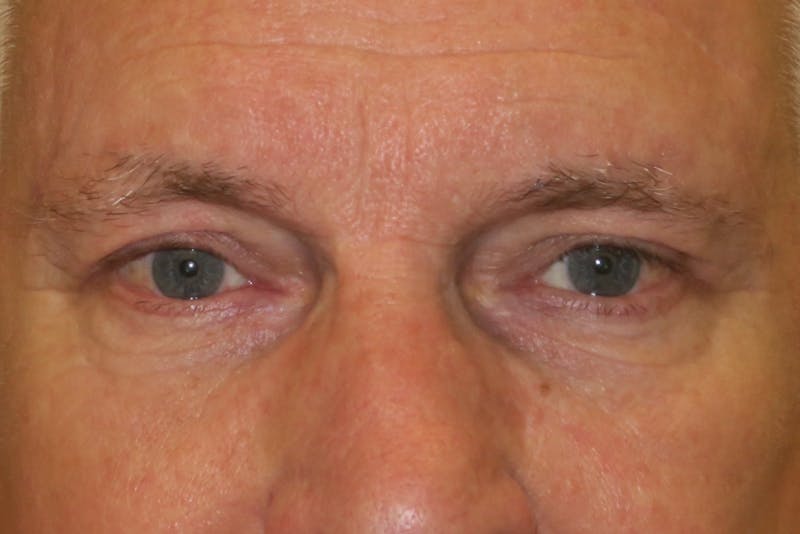 Ptosis Repair Before & After Gallery - Patient 149192813 - Image 2