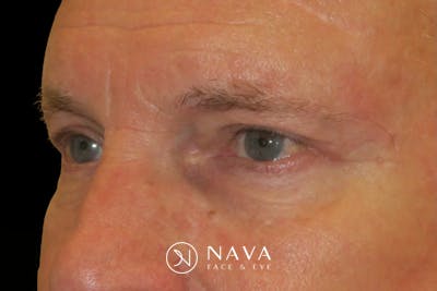 Ptosis Repair Before & After Gallery - Patient 149192813 - Image 6