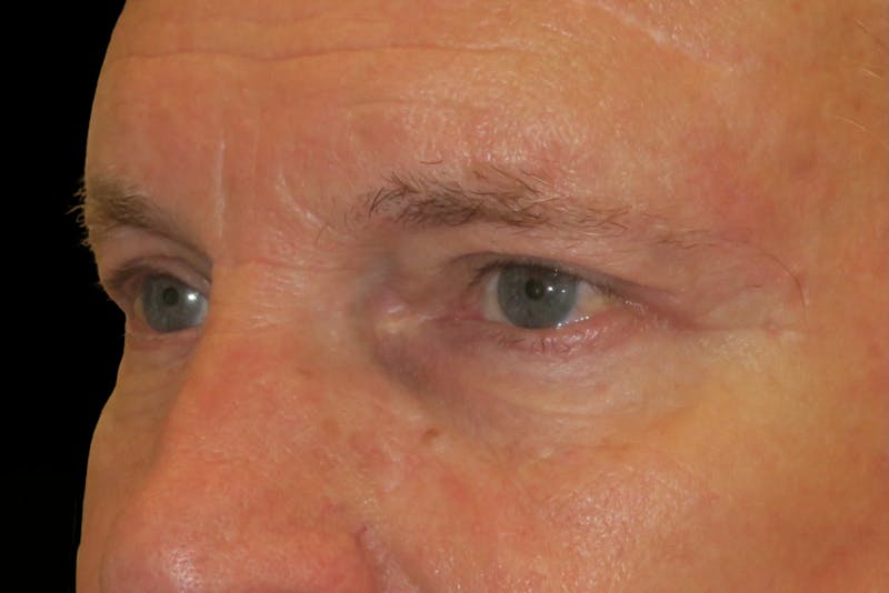 Ptosis Repair Before & After Gallery - Patient 149192813 - Image 6