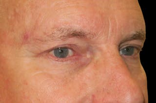 Browplasty (Brow Lift) Before & After Gallery - Patient 149192815 - Image 4