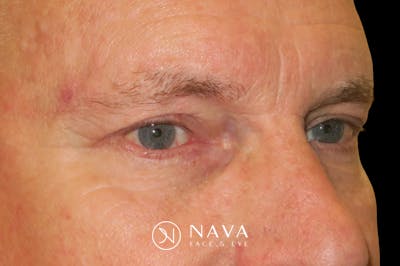 Ptosis Repair Before & After Gallery - Patient 149192813 - Image 4