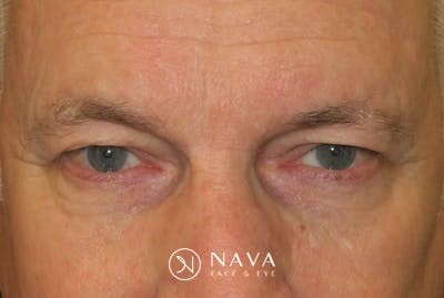 Ptosis Repair Before & After Gallery - Patient 149192813 - Image 1