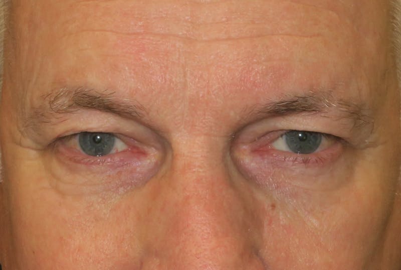 Browplasty (Brow Lift) Before & After Gallery - Patient 149192815 - Image 1