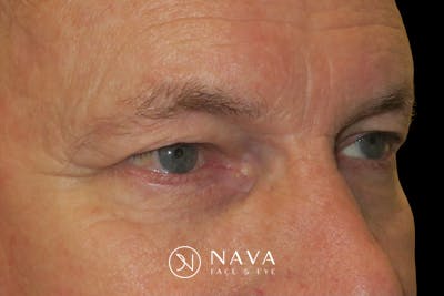 Ptosis Repair Before & After Gallery - Patient 149192813 - Image 3