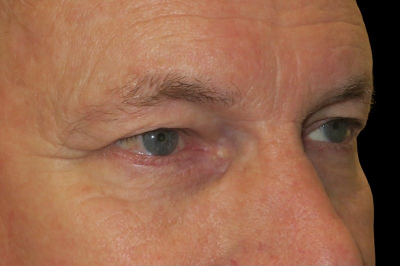 Browplasty (Brow Lift) Before & After Gallery - Patient 149192815 - Image 3