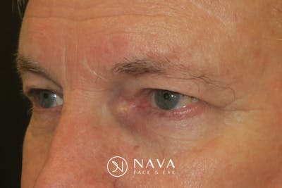 Ptosis Repair Before & After Gallery - Patient 149192813 - Image 5