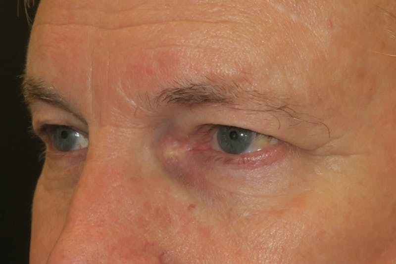 Ptosis Repair Before & After Gallery - Patient 149192813 - Image 5